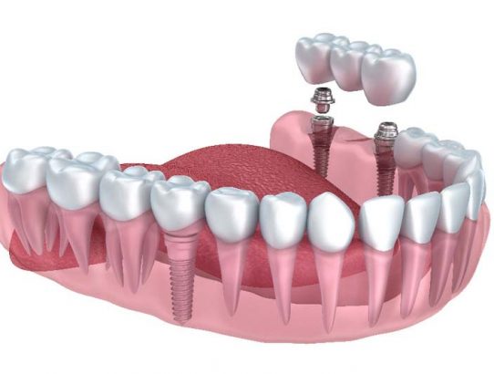 Dental Implants