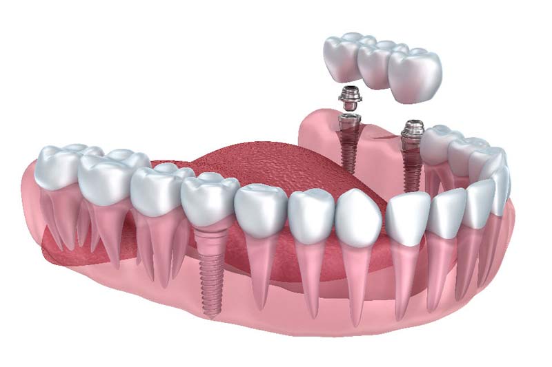 Dental Implants