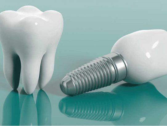 Dental Implants