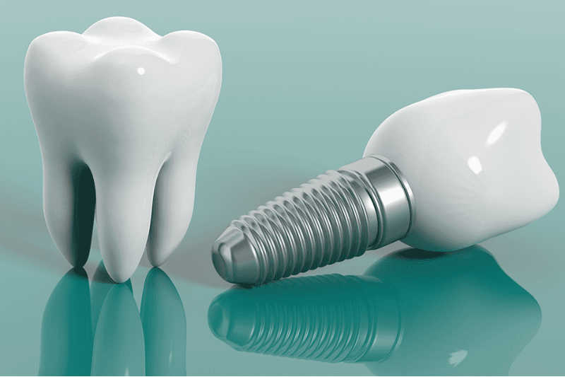 Dental Implants