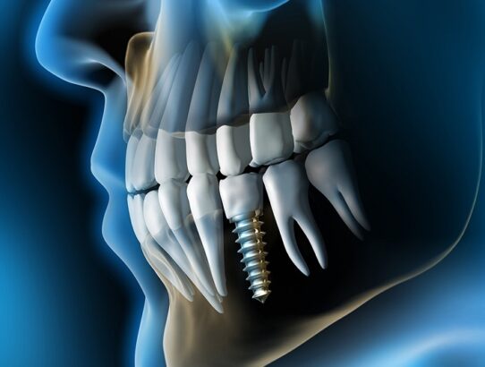 7 Benefits Of Dental Implants