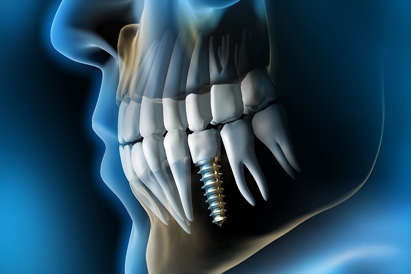 7 Benefits Of Dental Implants